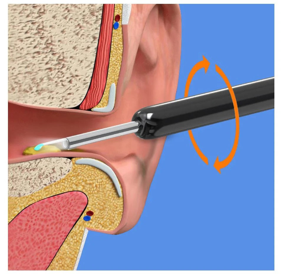 Professional Ear Wax Removal Kit – Safe & Reusable Ear Cleaner Tool Set